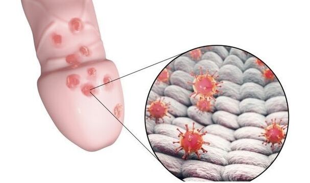 алергия към гел за уголемяване на пениса