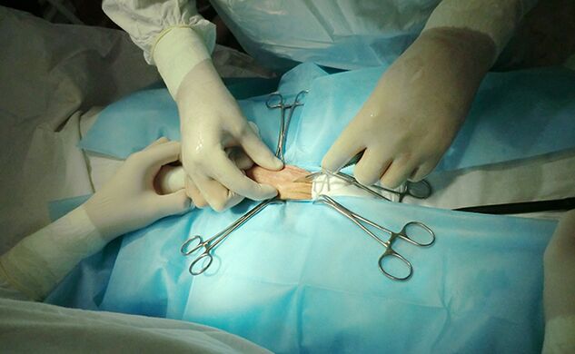 Операцията на репродуктивния орган ще помогне да се увеличи размерът му