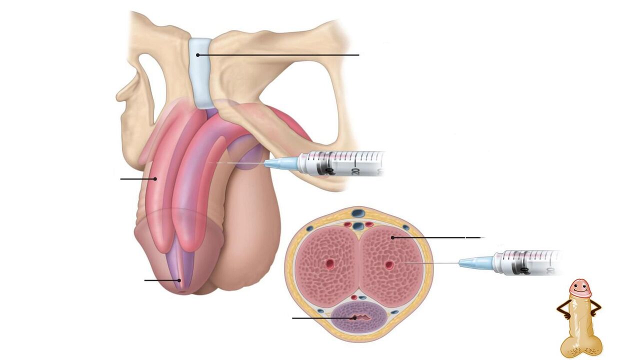 инжекции с хиалуронова киселина за уголемяване на пениса